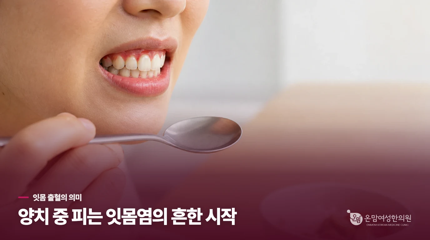 양치할 때 피가 나는 잇몸은 어떤 상태일까요?