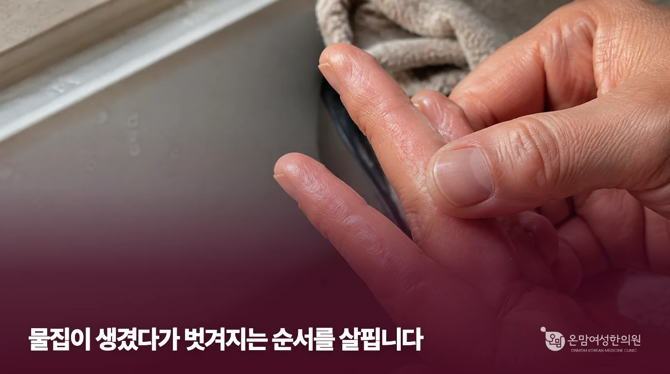손가락 옆 피부 변화를 보여주는 한포진 설명 이미지