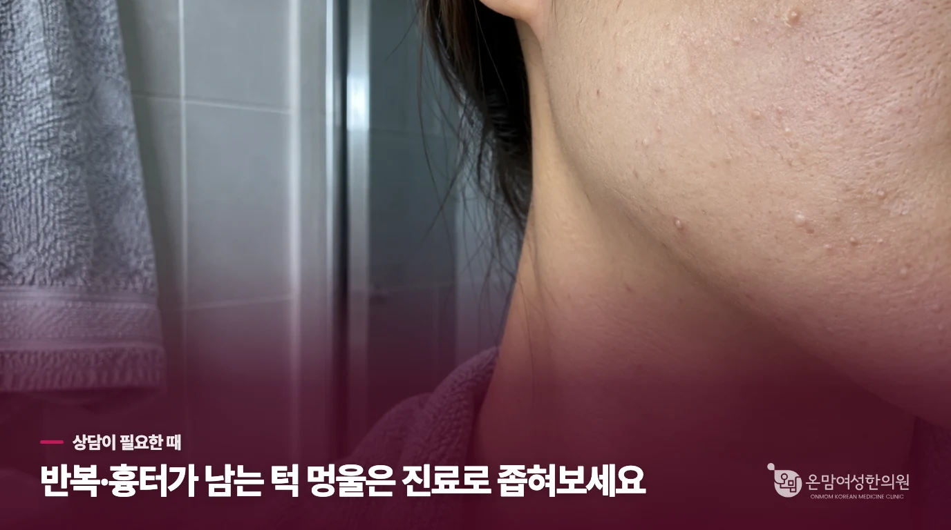 어떤 턱 여드름은 진료를 미루지 않는 편이 좋을까요?