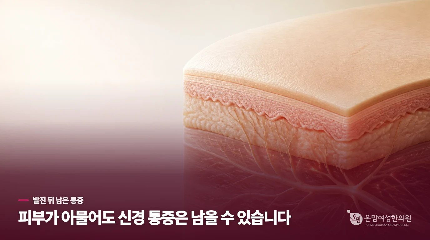 발진이 가라앉은 뒤에도 통증이 남는 이유