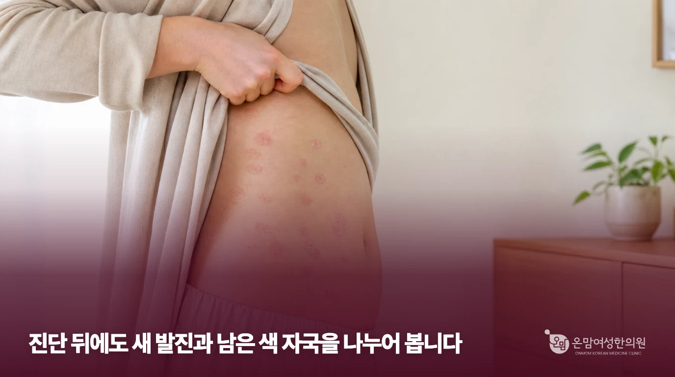 옷 아래 몸통에 작은 타원형 발진이 보이는 설명 이미지